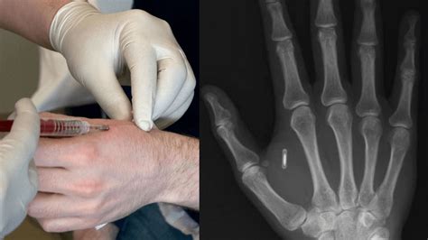 first rfid chips|rfid chip implant near me.